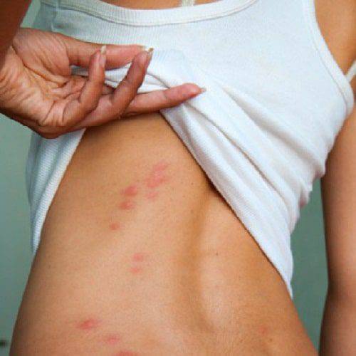 زخم بستر چیست و در کجای بدن بیشتر اتفاق می‌افتد